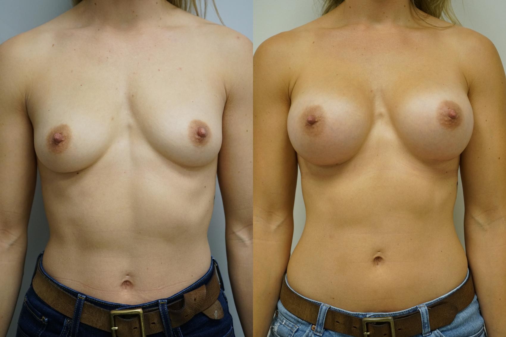 Before & After Breast Augmentation Case 445 Front View in Gilbert, AZ