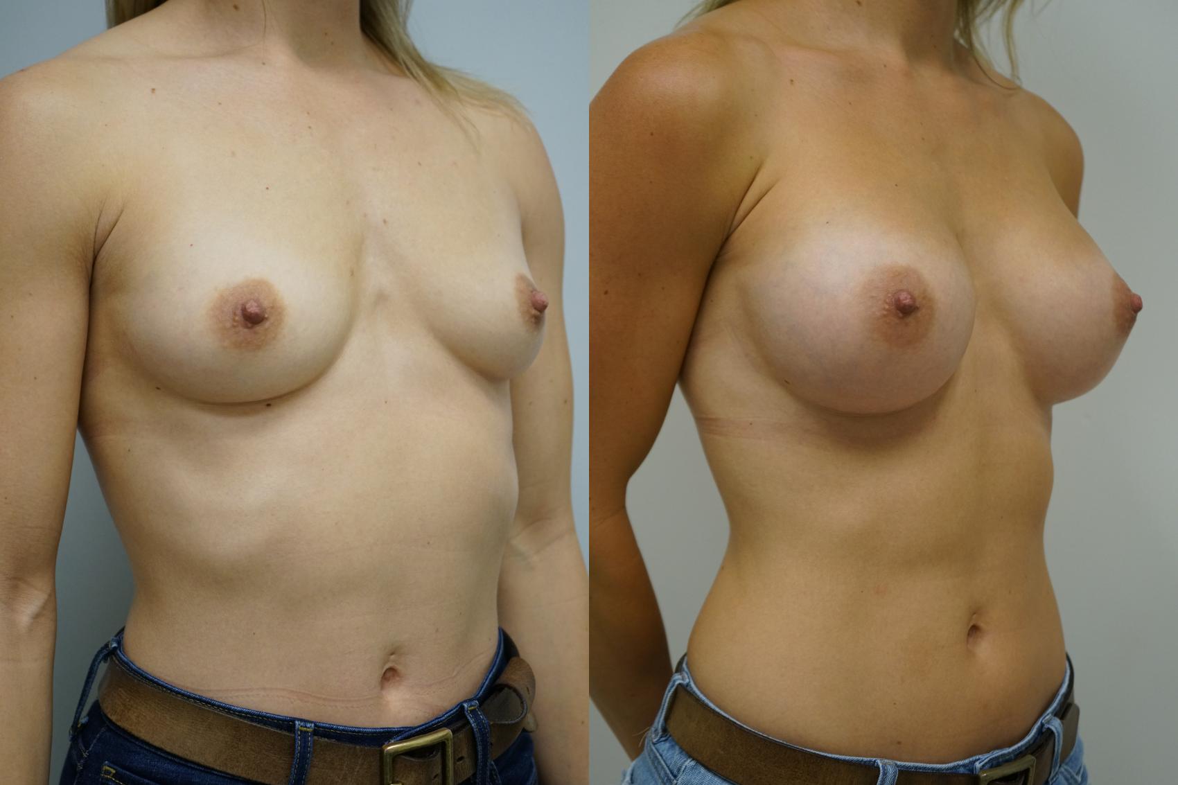 Before & After Breast Augmentation Case 445 Right Oblique View in Gilbert, AZ