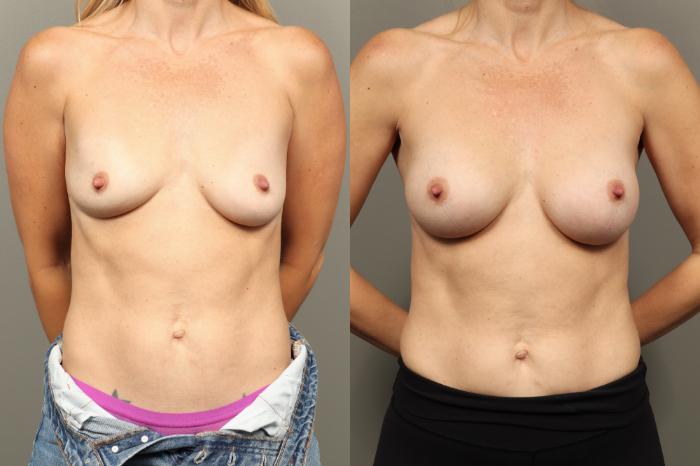 Before & After Breast Augmentation Case 449 Front View in Gilbert, AZ