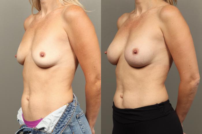 Before & After Breast Augmentation Case 449 Left Oblique View in Gilbert, AZ