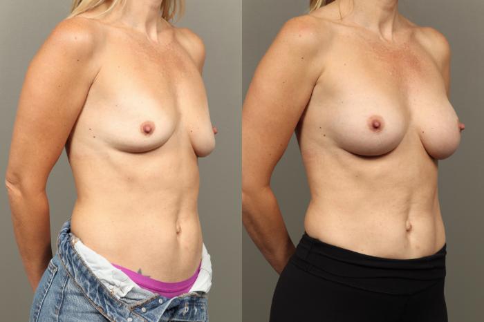 Before & After Breast Augmentation Case 449 Right Oblique View in Gilbert, AZ