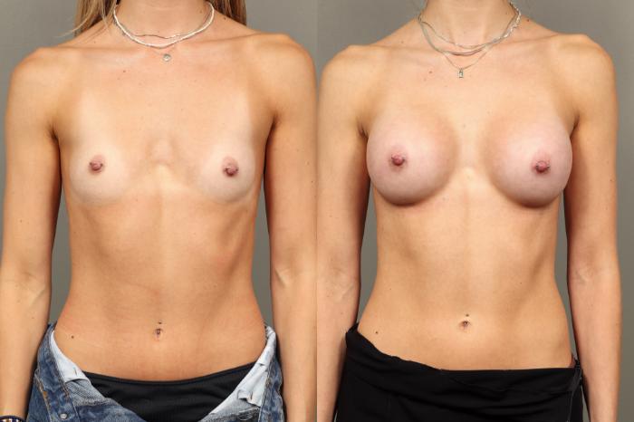 Before & After Breast Augmentation Case 450 Front View in Gilbert, AZ