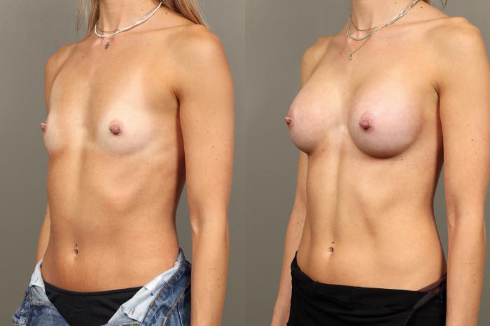 Before & After Breast Augmentation Case 450 Left Oblique View in Gilbert, AZ