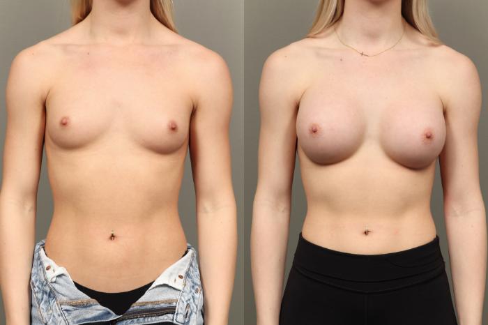 Before & After Breast Augmentation Case 451 Front View in Gilbert, AZ