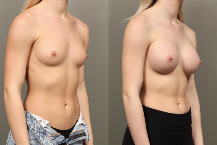 Before & After Breast Augmentation Case 451 Right Oblique View in Gilbert, AZ