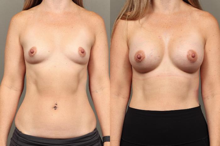 Before & After Breast Augmentation Case 452 Front View in Gilbert, AZ