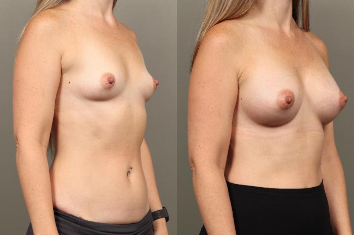 Before & After Breast Augmentation Case 452 Right Oblique View in Gilbert, AZ