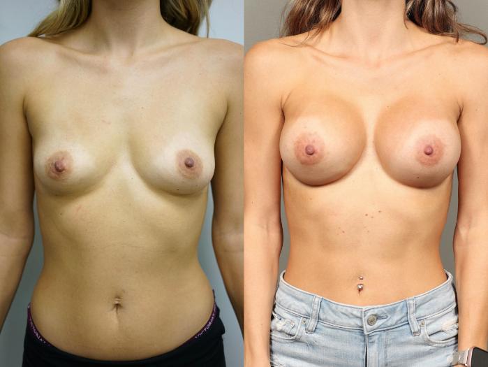 Before & After Breast Augmentation Case 453 Front View in Gilbert, AZ