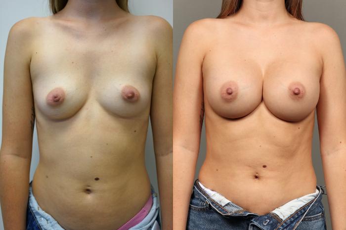 Before & After Breast Augmentation Case 456 Front View in Gilbert, AZ