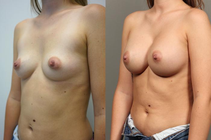 Before & After Breast Augmentation Case 456 Left Oblique View in Gilbert, AZ