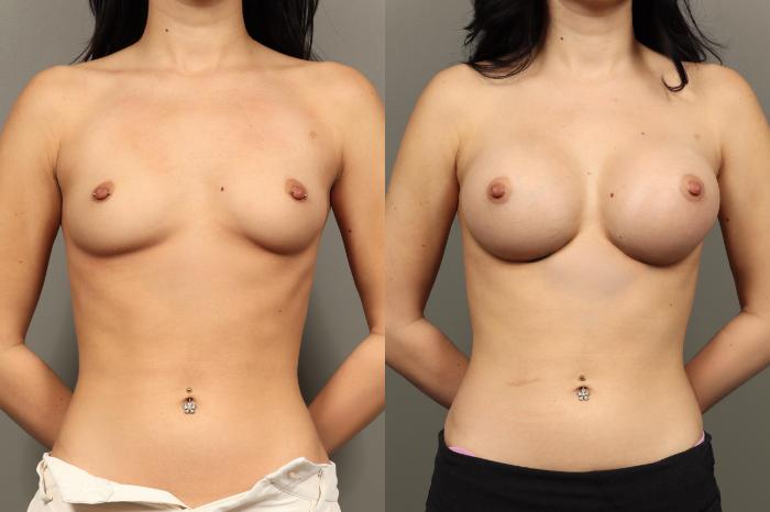 Before & After Breast Augmentation Case 458 Front View in Gilbert, AZ