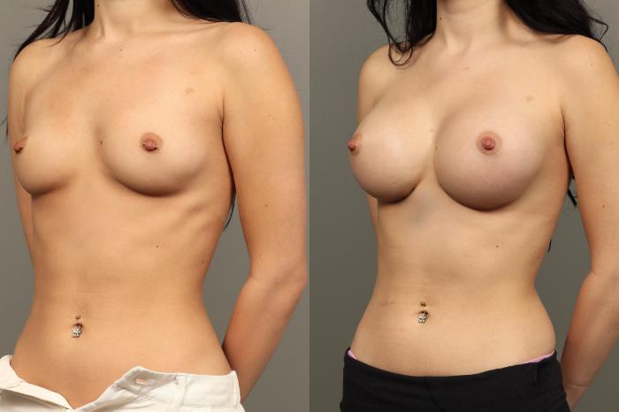 Before & After Breast Augmentation Case 458 Left Oblique View in Gilbert, AZ