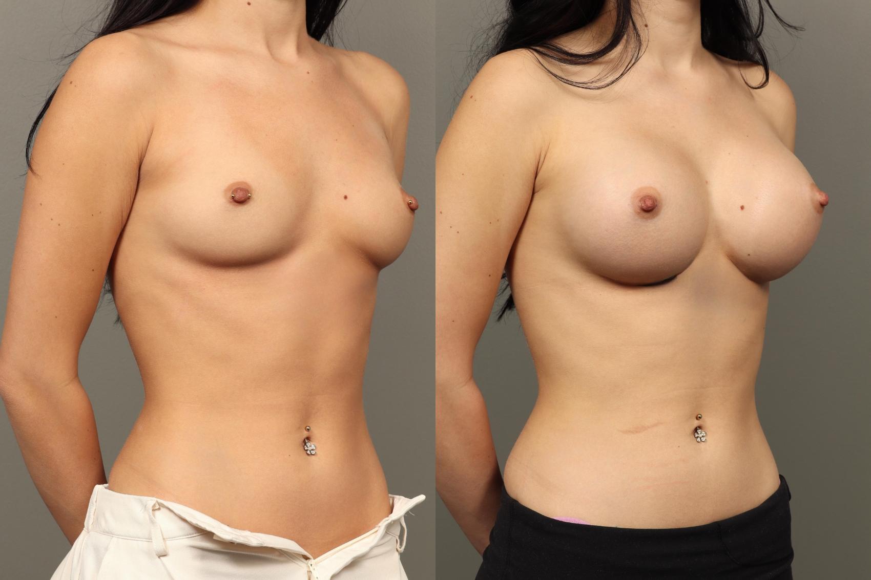 Before & After Breast Augmentation Case 458 Right Oblique View in Gilbert, AZ