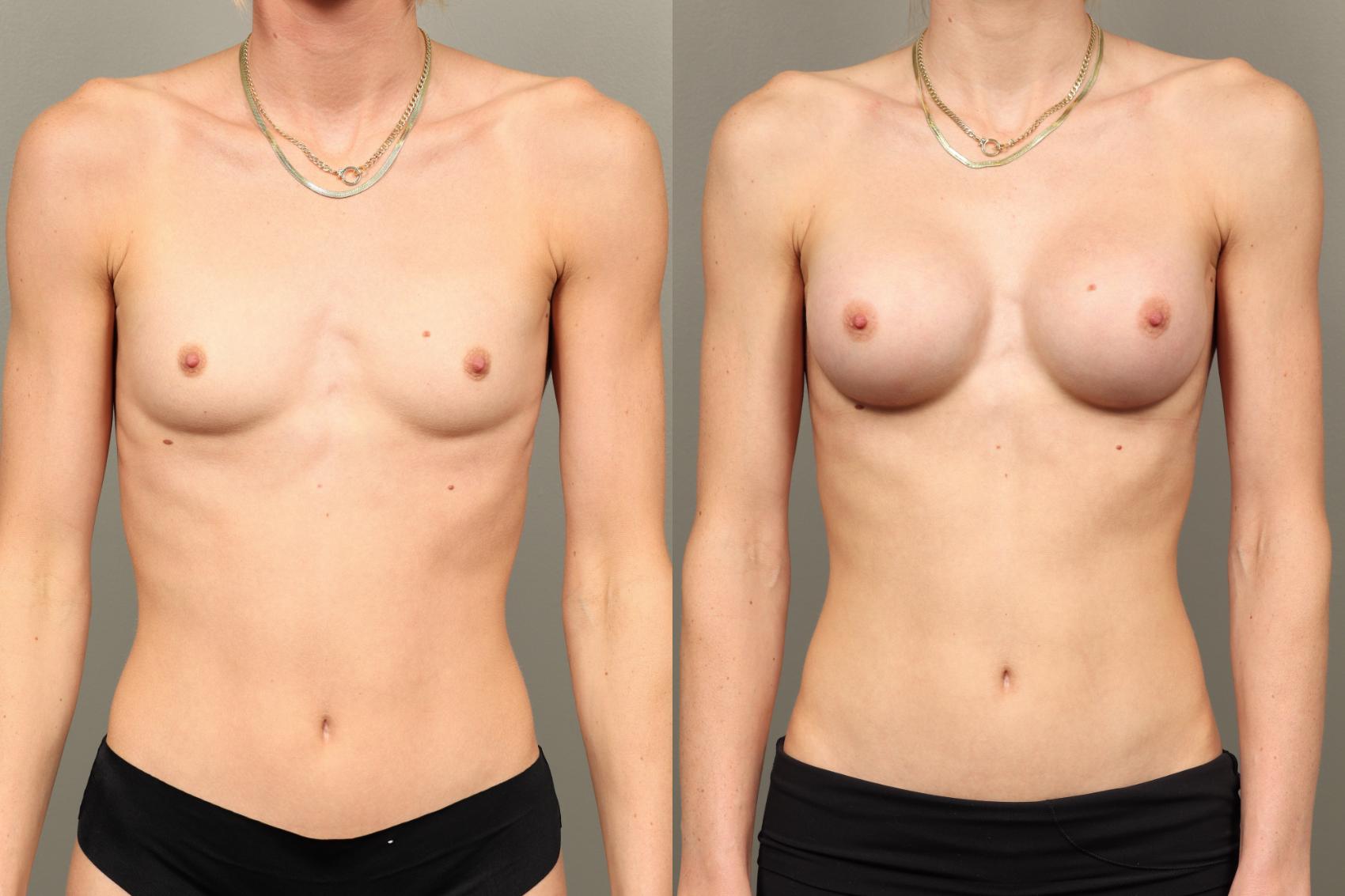 Before & After Breast Augmentation Case 464 Front View in Gilbert, AZ
