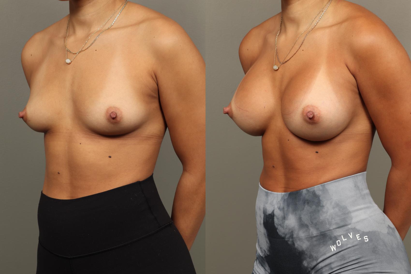 Before & After Breast Augmentation Case 468 Left Oblique View in Gilbert, AZ