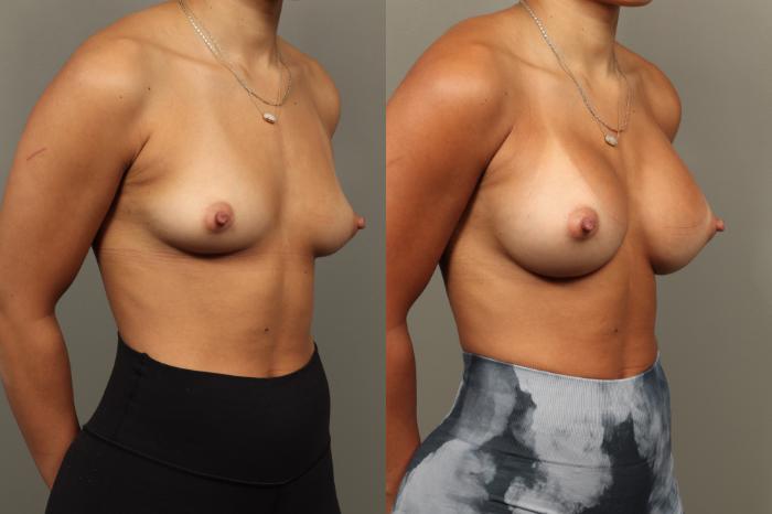 Before & After Breast Augmentation Case 468 Right Oblique View in Gilbert, AZ