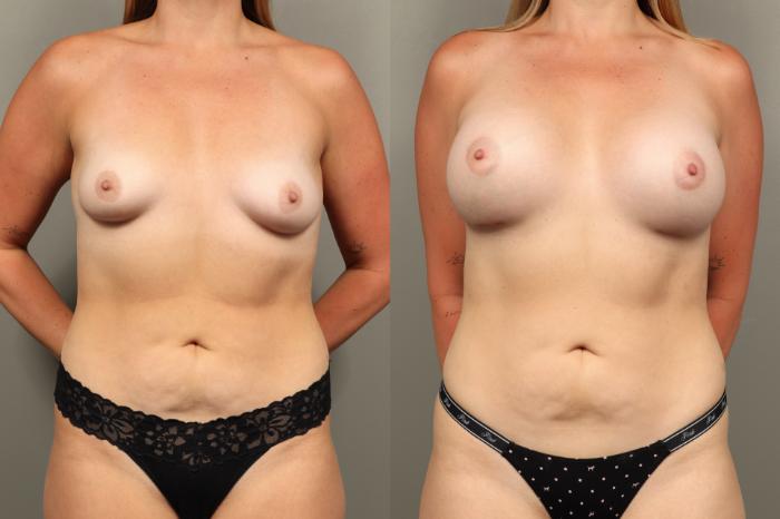 Before & After Breast Augmentation Case 469 Front View in Gilbert, AZ