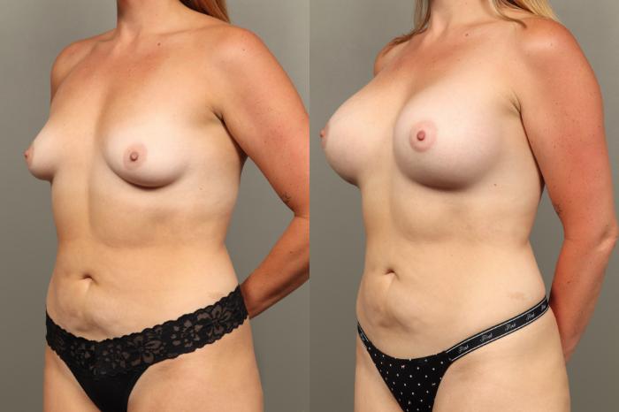 Before & After Breast Augmentation Case 469 Left Oblique View in Gilbert, AZ