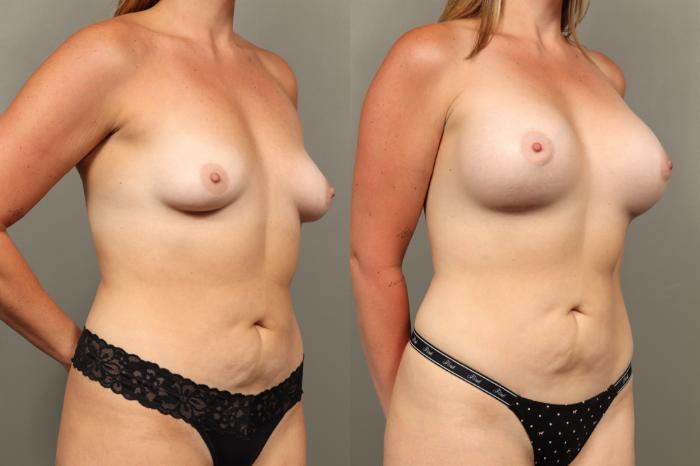 Before & After Breast Augmentation Case 469 Right Oblique View in Gilbert, AZ