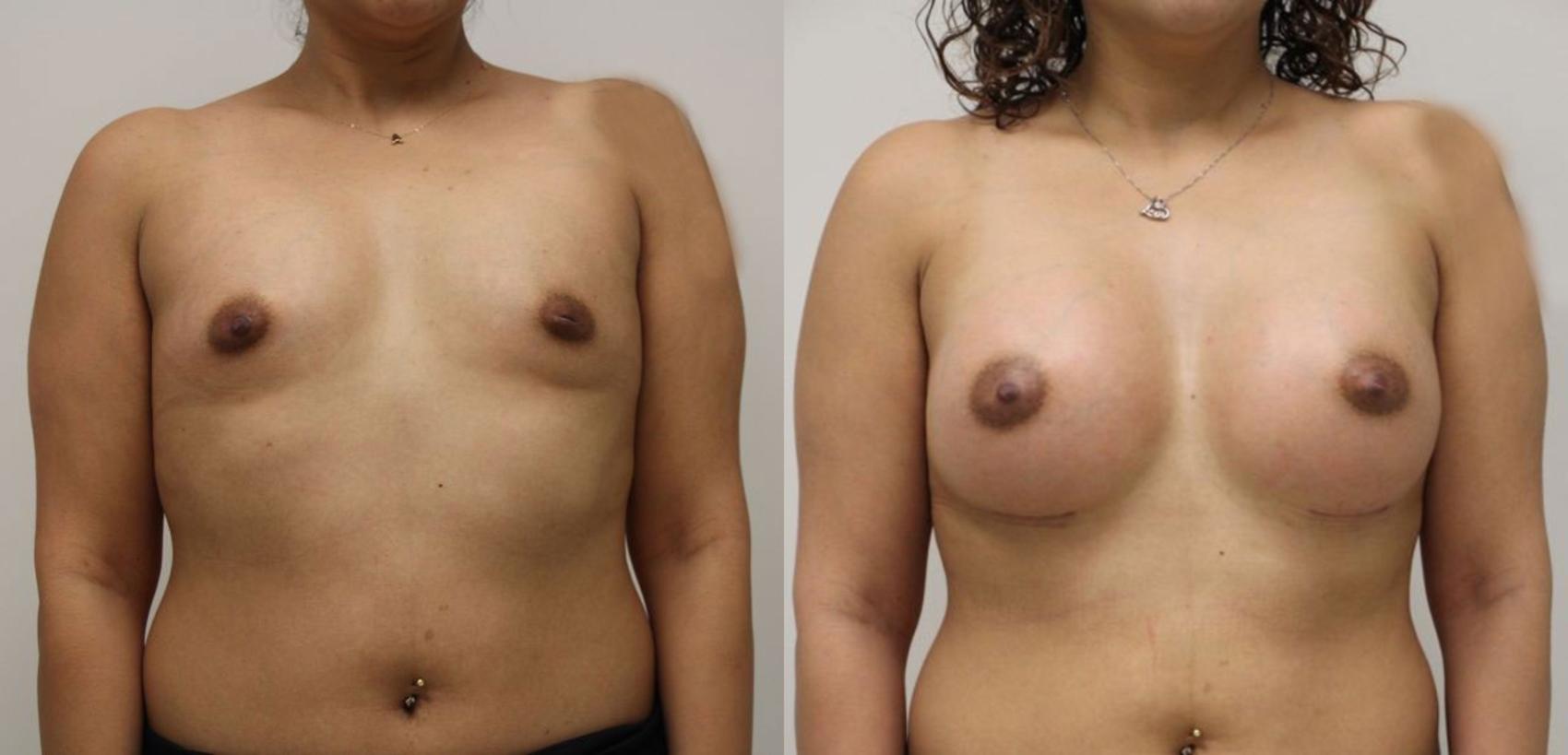 Before & After Breast Augmentation Case 47 View #1 View in Gilbert, AZ