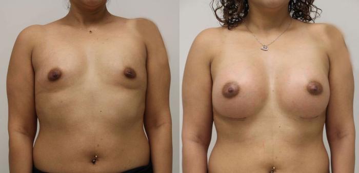 Before & After Breast Augmentation Case 47 View #1 View in Gilbert, AZ