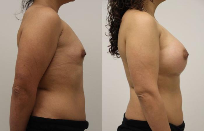 Before & After Breast Augmentation Case 47 View #3 View in Gilbert, AZ