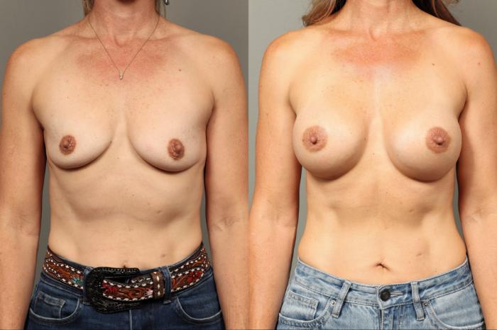 Before & After Breast Augmentation Case 470 Front View in Gilbert, AZ