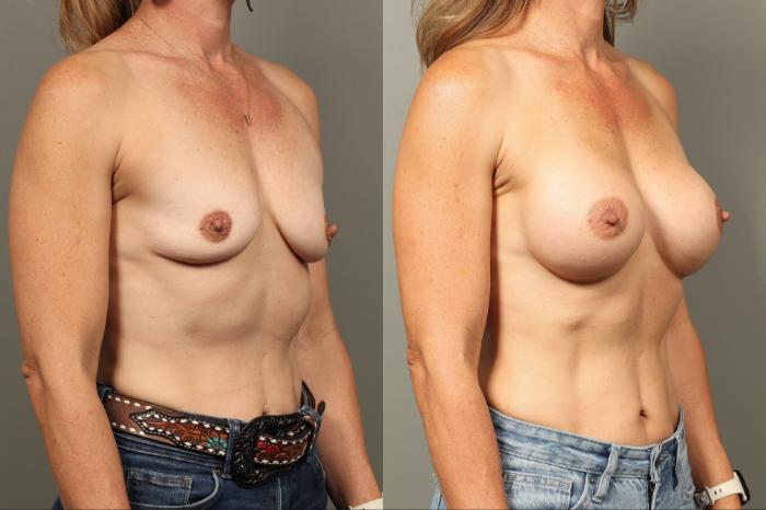 Before & After Breast Augmentation Case 470 Right Oblique View in Gilbert, AZ