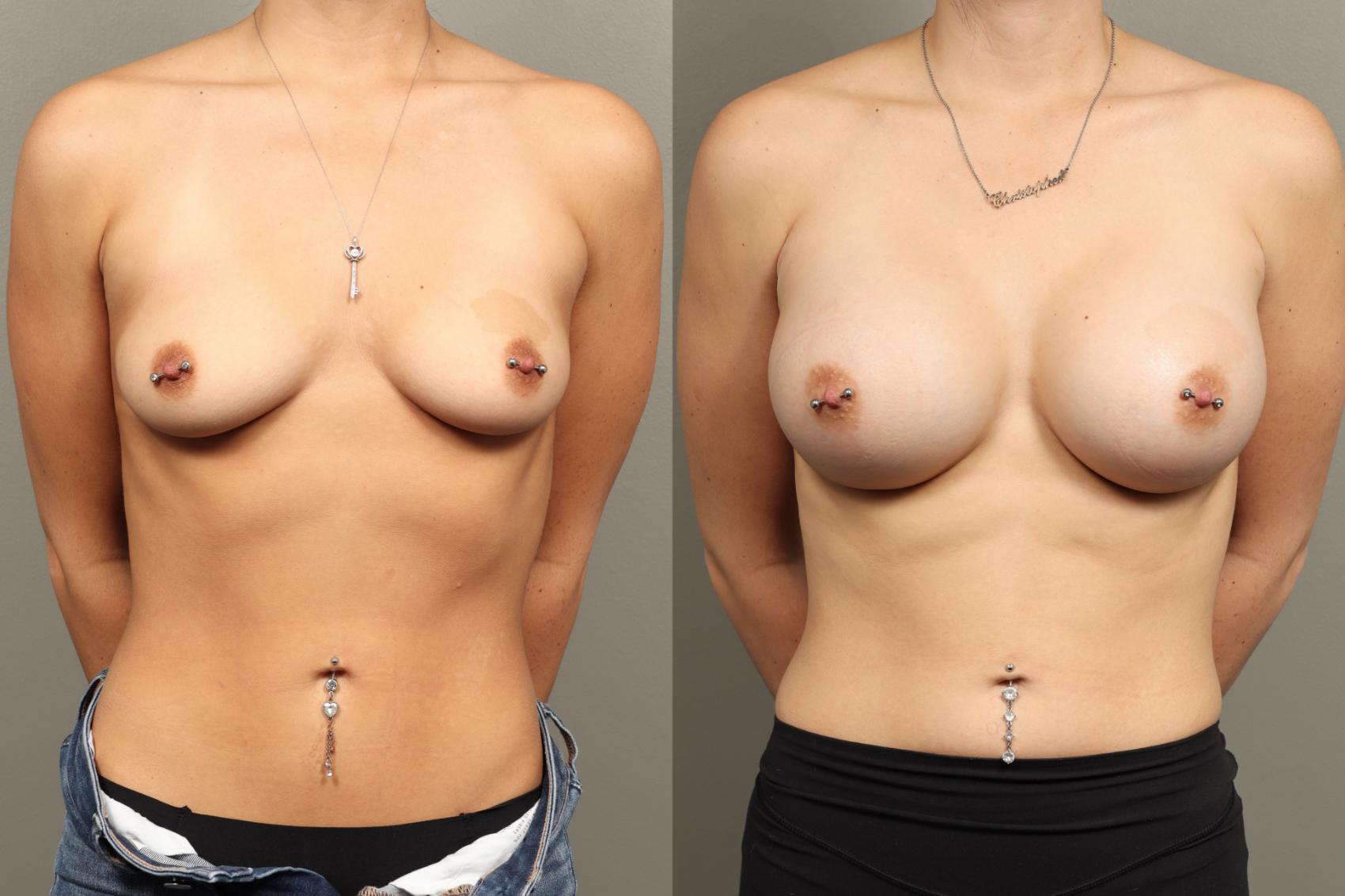 Before & After Breast Augmentation Case 471 Front View in Gilbert, AZ