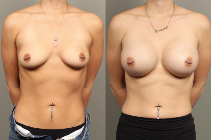 Before & After Breast Augmentation Case 471 Front View in Gilbert, AZ