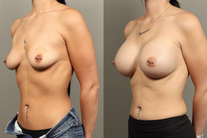 Before & After Breast Augmentation Case 471 Left Oblique View in Gilbert, AZ