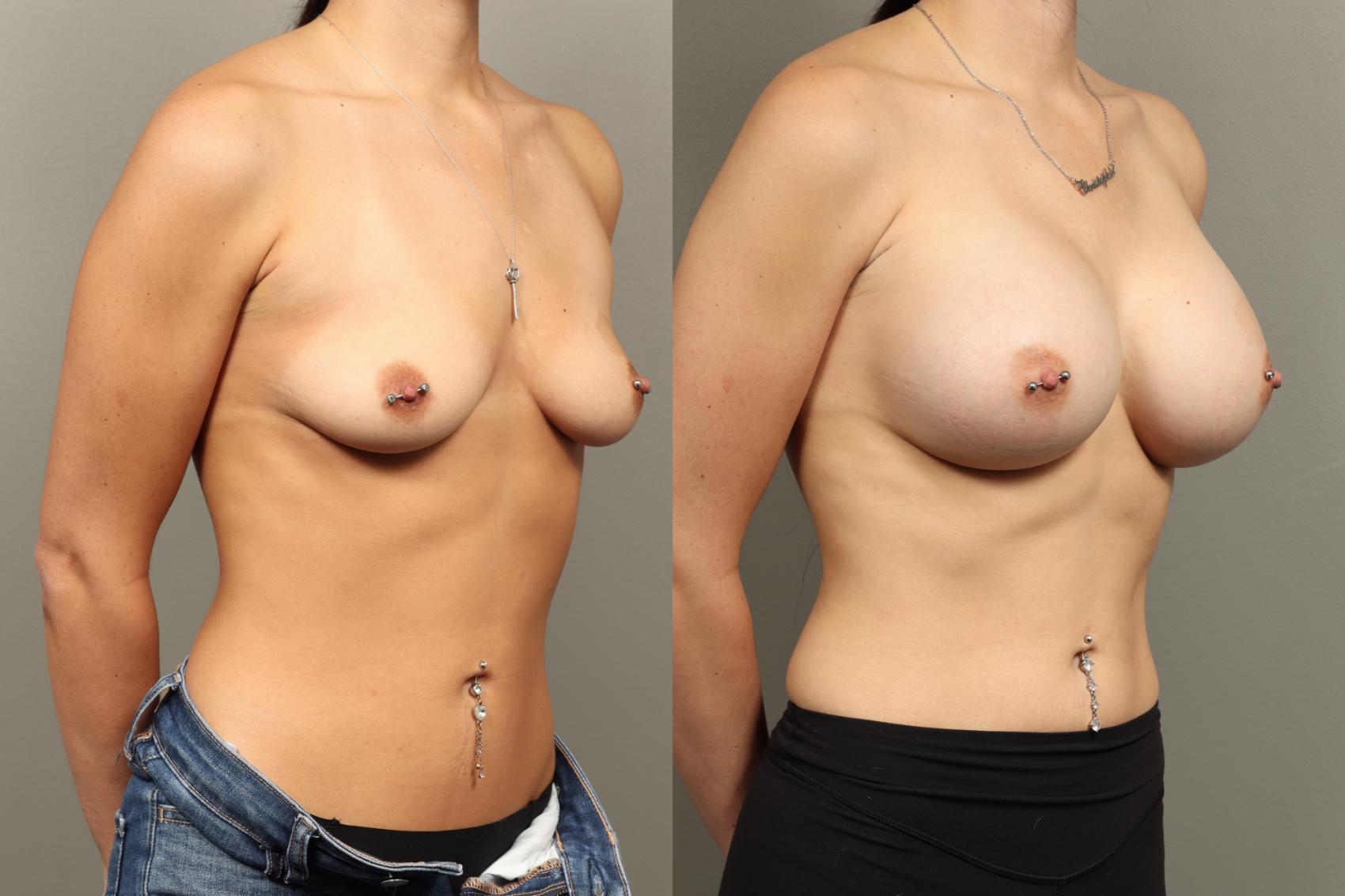 Before & After Breast Augmentation Case 471 Right Oblique View in Gilbert, AZ