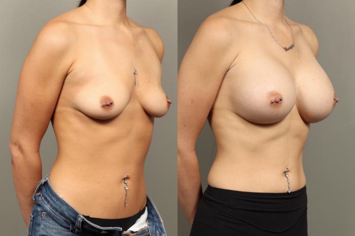 Before & After Breast Augmentation Case 471 Right Oblique View in Gilbert, AZ