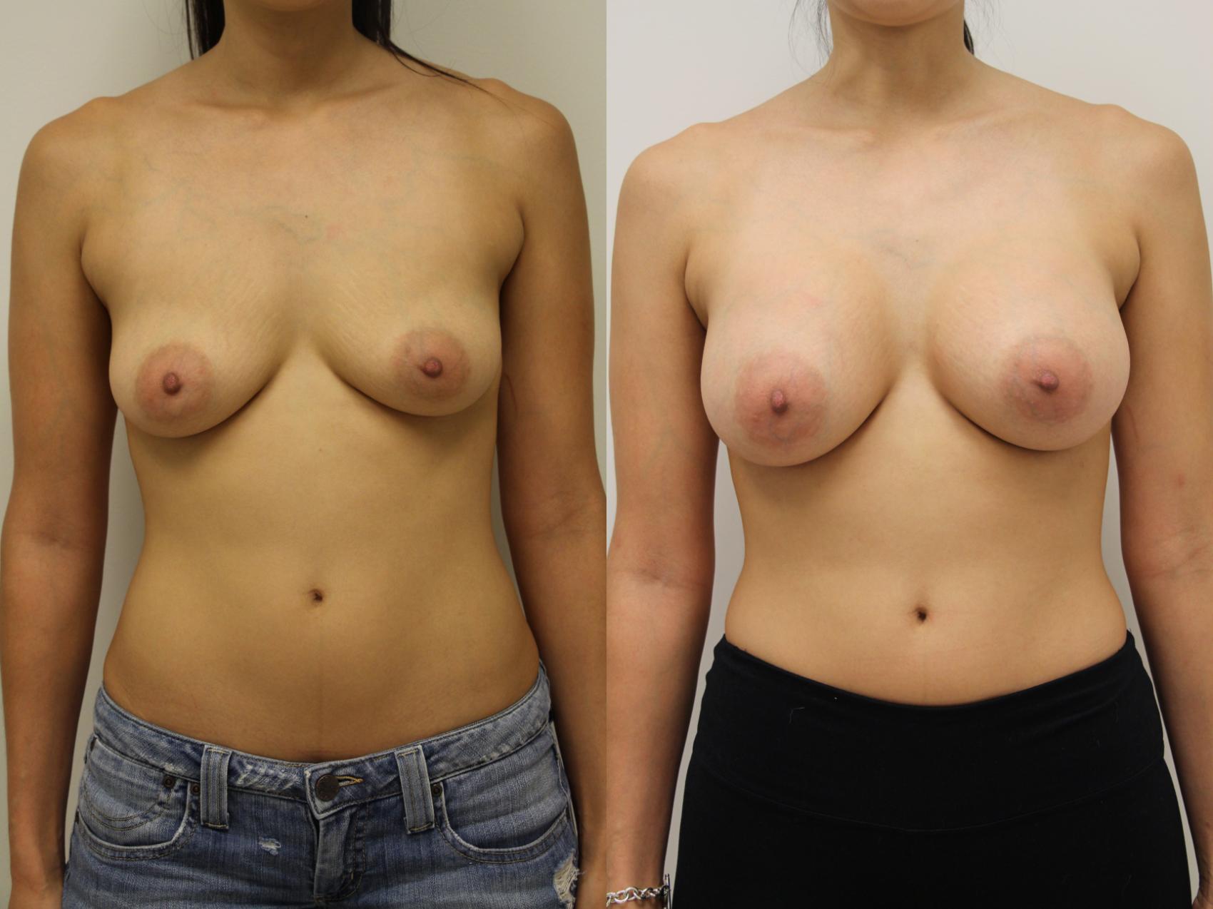 Before & After Breast Augmentation Case 49 View #1 View in Gilbert, AZ