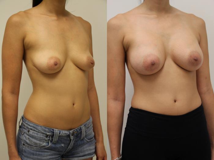 Before & After Breast Augmentation Case 49 View #2 View in Gilbert, AZ