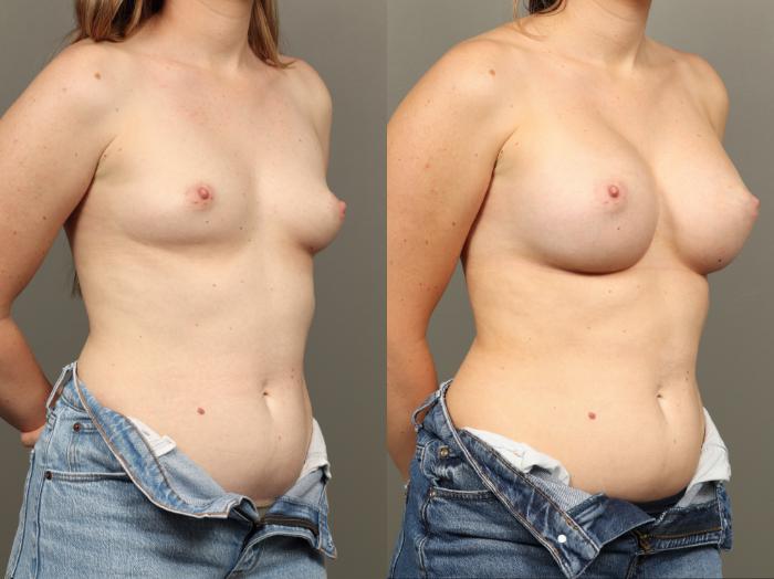 Before & After Breast Augmentation Case 492 Right Oblique View in Gilbert, AZ