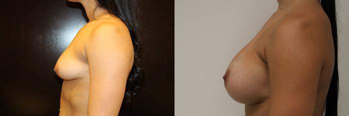 Before & After Breast Augmentation Case 50 View #2 View in Gilbert, AZ