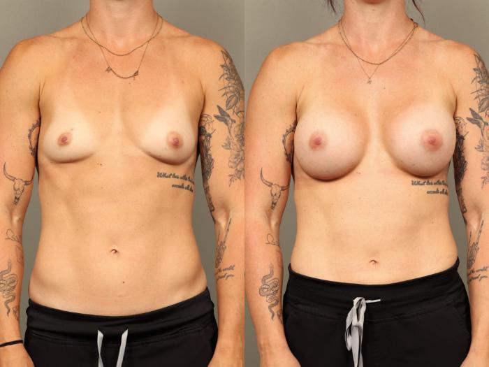 Before & After Breast Augmentation Case 508 Front View in Gilbert, AZ