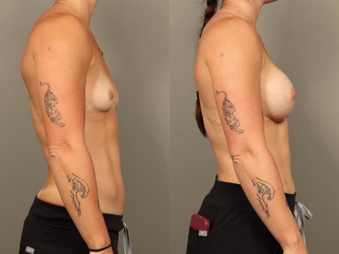 Before & After Breast Augmentation Case 508 Left Side View in Gilbert, AZ