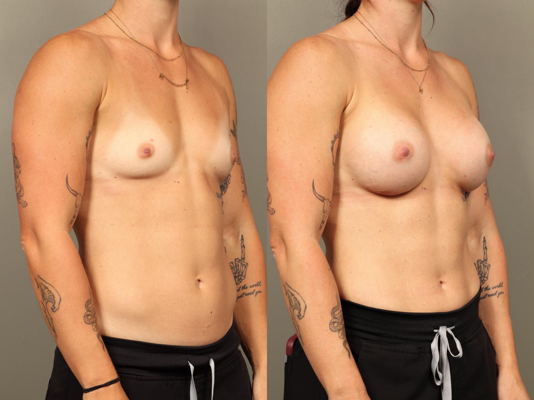Before & After Breast Augmentation Case 508 Right Oblique View in Gilbert, AZ