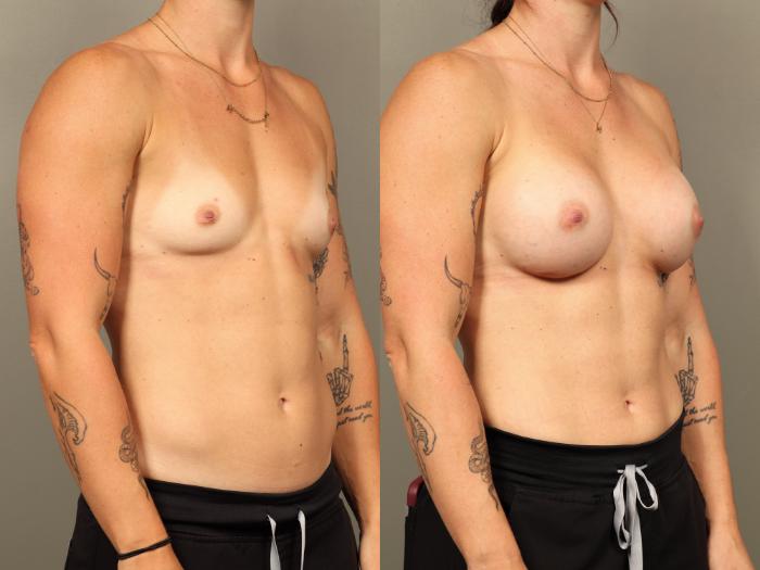 Before & After Breast Augmentation Case 508 Right Oblique View in Gilbert, AZ