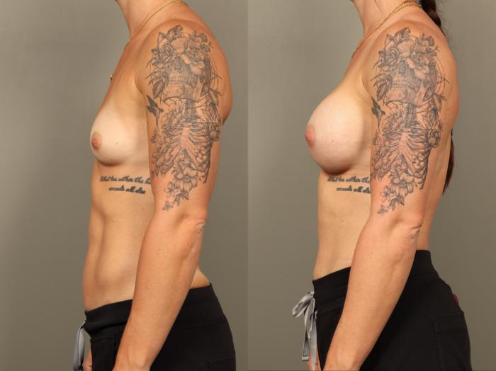 Before & After Breast Augmentation Case 508 Right Side View in Gilbert, AZ