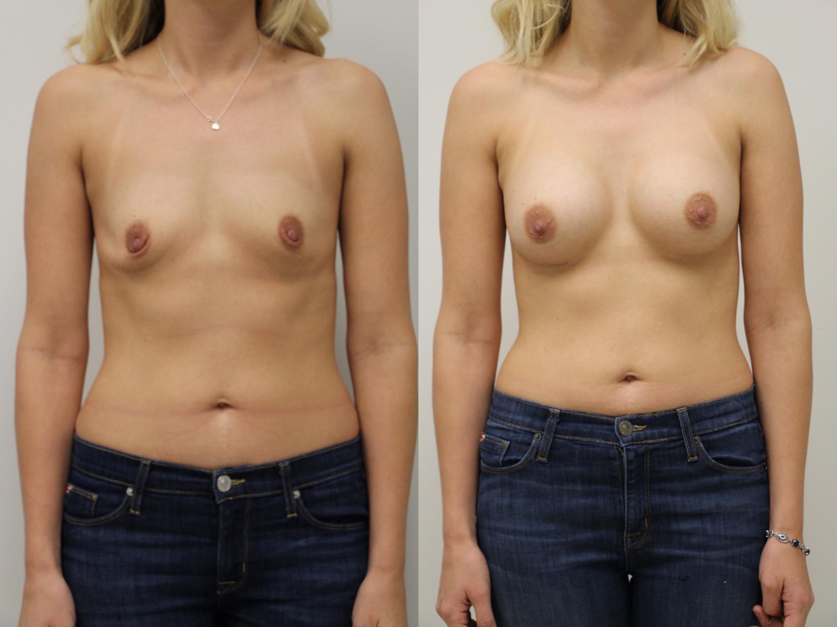 Before & After Breast Augmentation Case 51 View #1 View in Gilbert, AZ