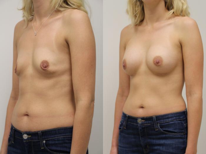 Before & After Breast Augmentation Case 51 View #2 View in Gilbert, AZ