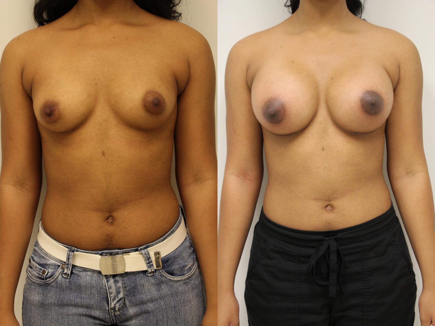 Before & After Breast Augmentation Case 52 View #1 View in Gilbert, AZ