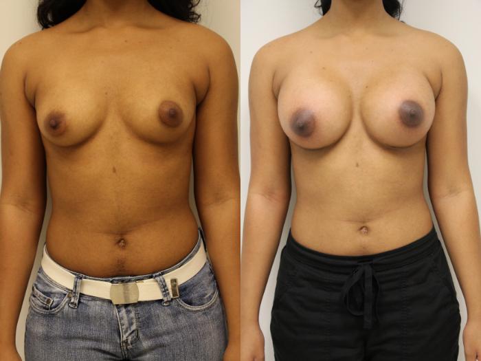 Before & After Breast Augmentation Case 52 View #1 View in Gilbert, AZ