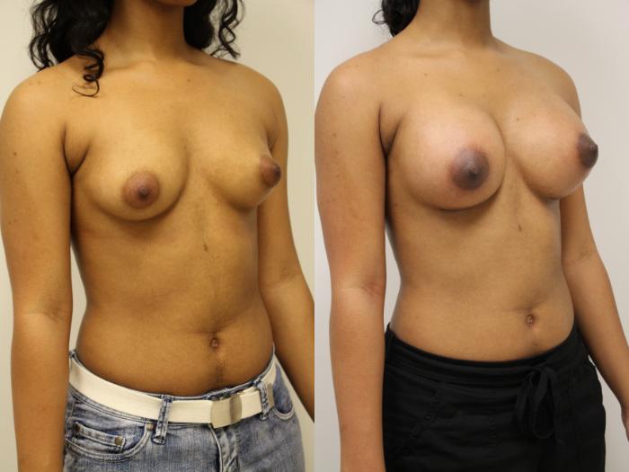 Before & After Breast Augmentation Case 52 View #2 View in Gilbert, AZ
