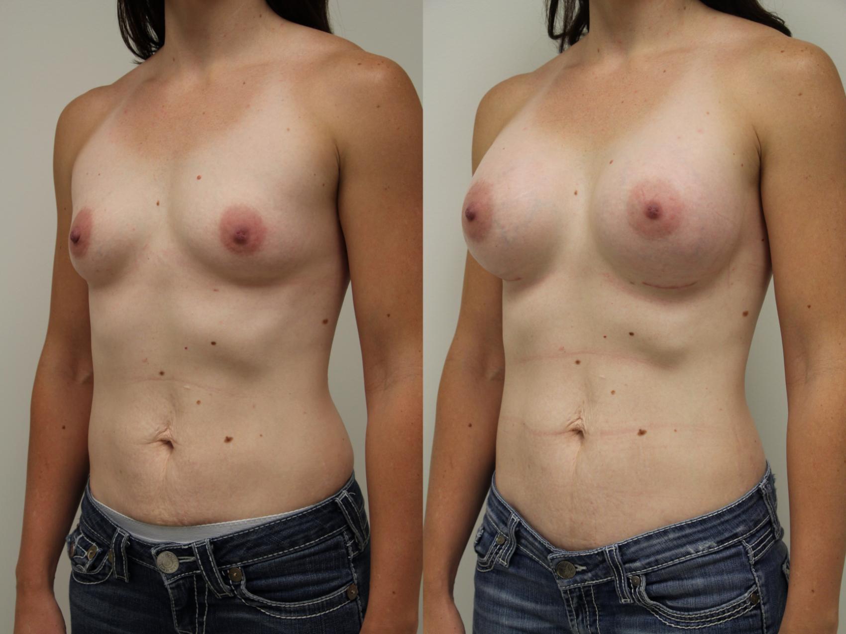 Before & After Breast Augmentation Case 53 View #1 View in Gilbert, AZ