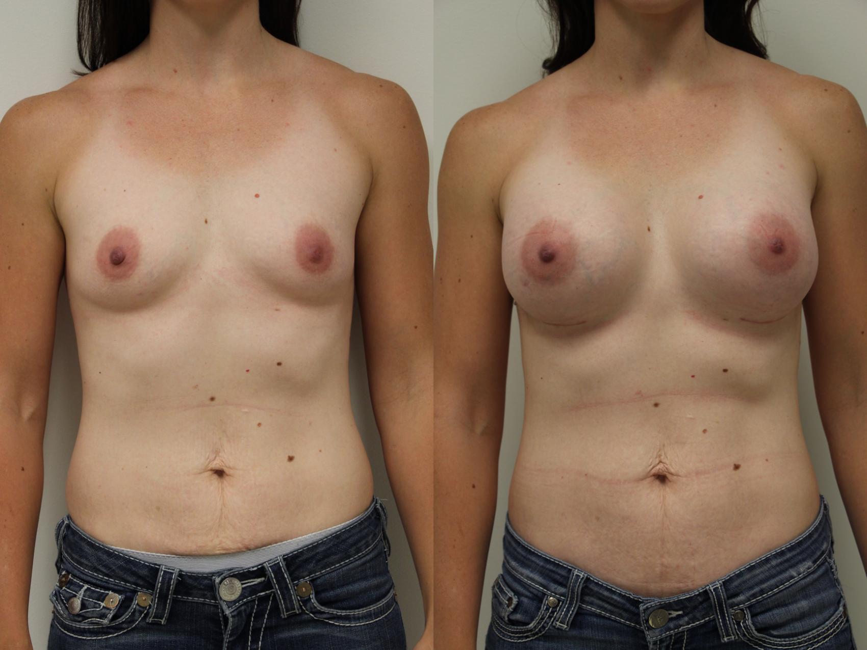 Before & After Breast Augmentation Case 53 View #2 View in Gilbert, AZ