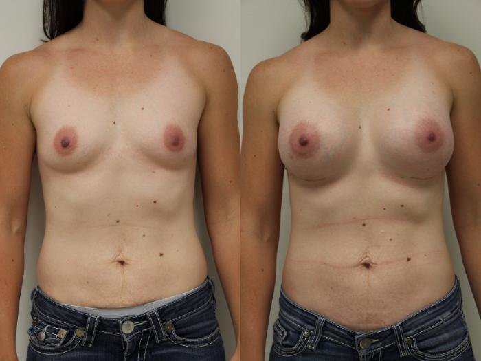 Before & After Breast Augmentation Case 53 View #2 View in Gilbert, AZ